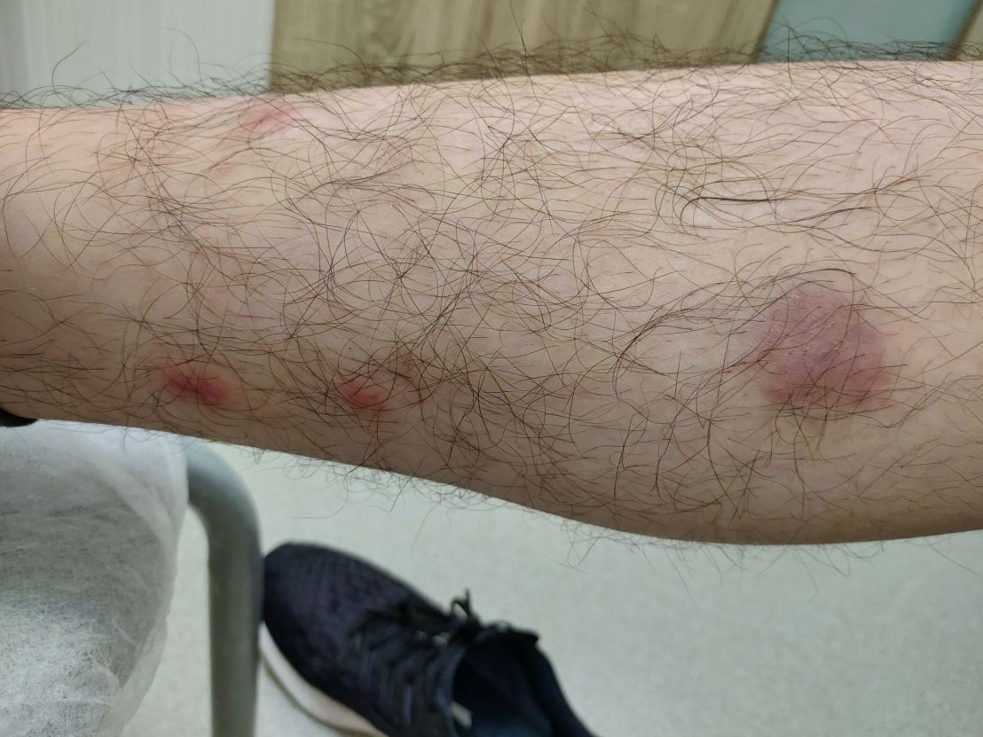 結節性紅斑 erythema nodosum-3 治療後一周