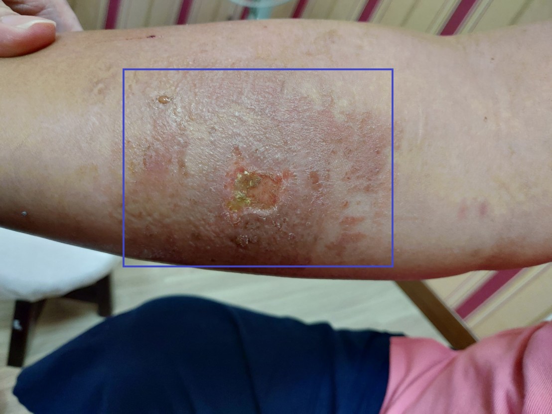 contact dermatitis-1