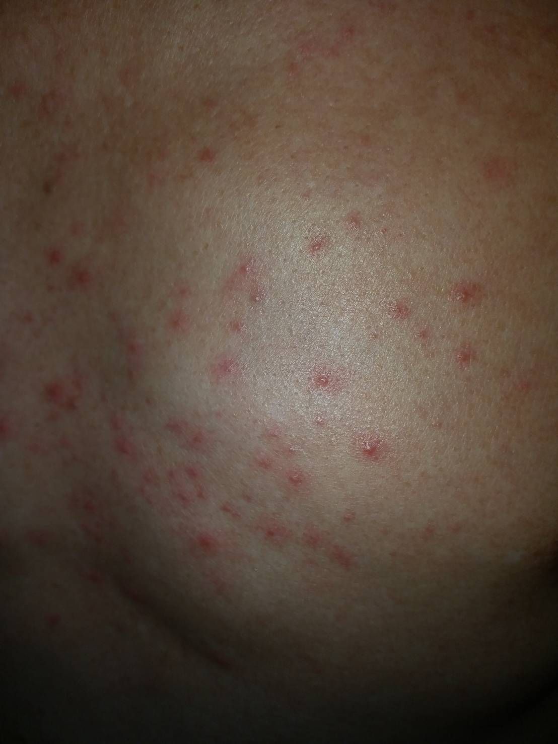 皮屑芽孢菌毛囊炎